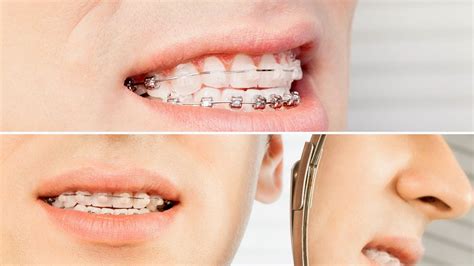 diferencia brackets metalicos y zafiro|brackets linguales precio.